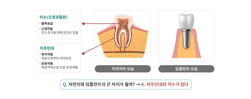 임플란트 구조 관련 이미지