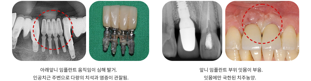 임플란트 주의사항 2