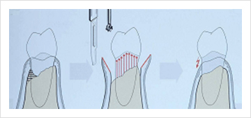 근처치 수술과정(radical surgical procedure) 관련 이미지1