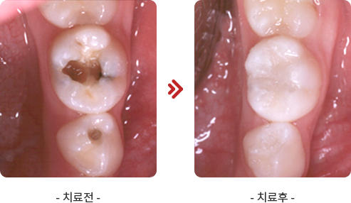 레진치료 관련 이미지