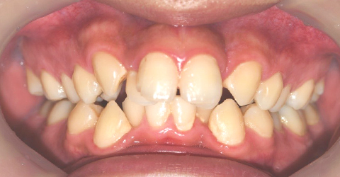 치아가 가지런하지 않은 경우 관련 이미지1